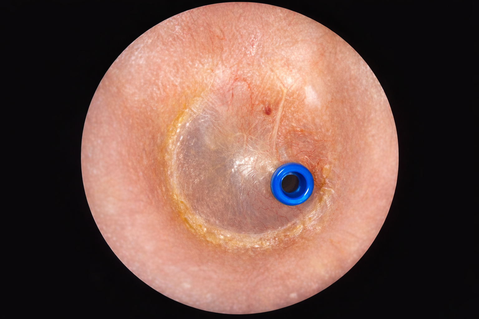 滲出性中耳炎チューブ留置術後