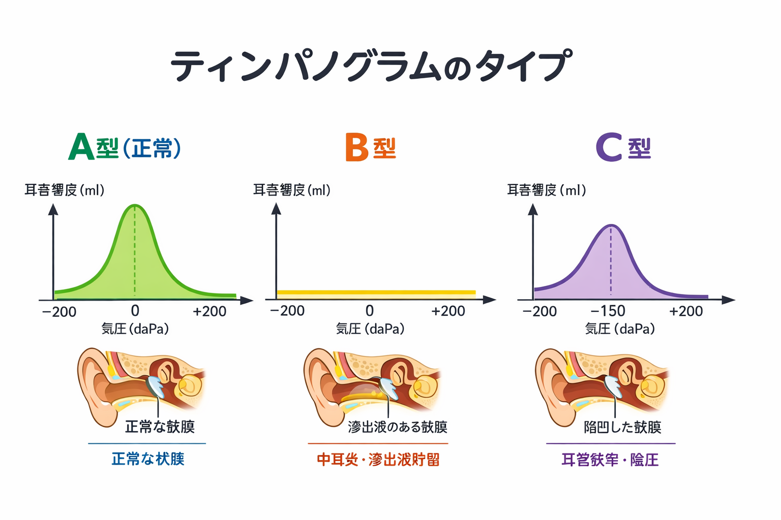 ティンパノグラム
